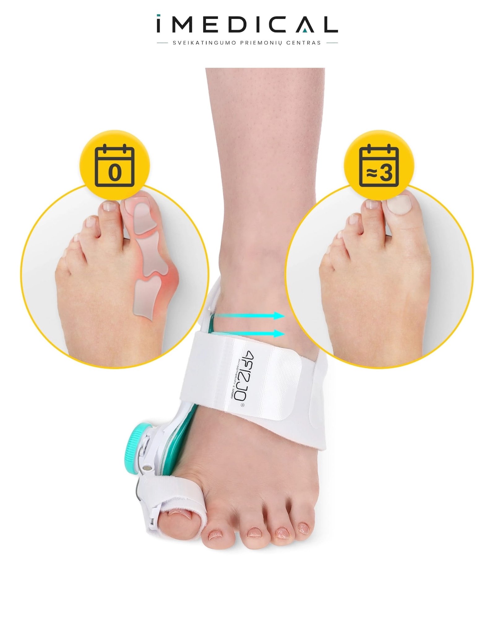 Didžiojo Kojos Piršto Korektorius – Reguliuojamas Hallux Valgus Įtvaras Kojų pirštų įtvarai